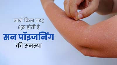 शरीर में कैसे शुरू होता है फोटोडर्मेटाइटिस (सन पॉइजनिंग), जानें इस त्वचा रोग के बारे में