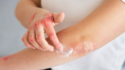 Is Your Skin Rash Not Going Away? Here Are Some Diseases That May Be Causing It