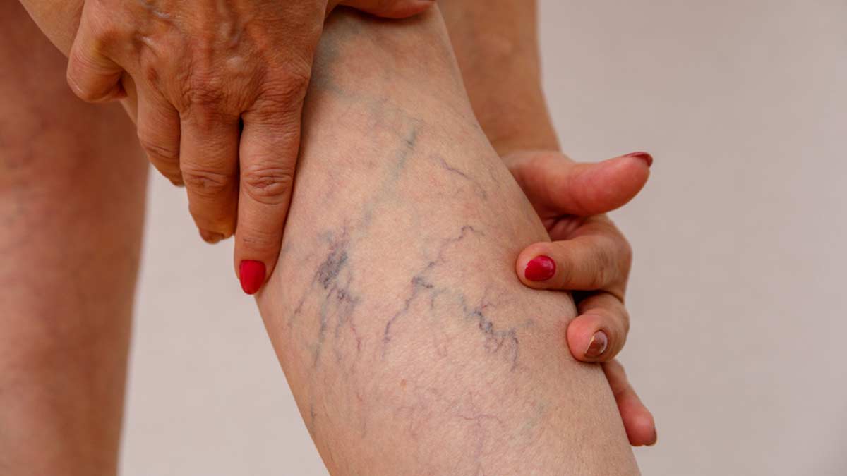 Varicose Veins And Spider Veins: Are They The Same?