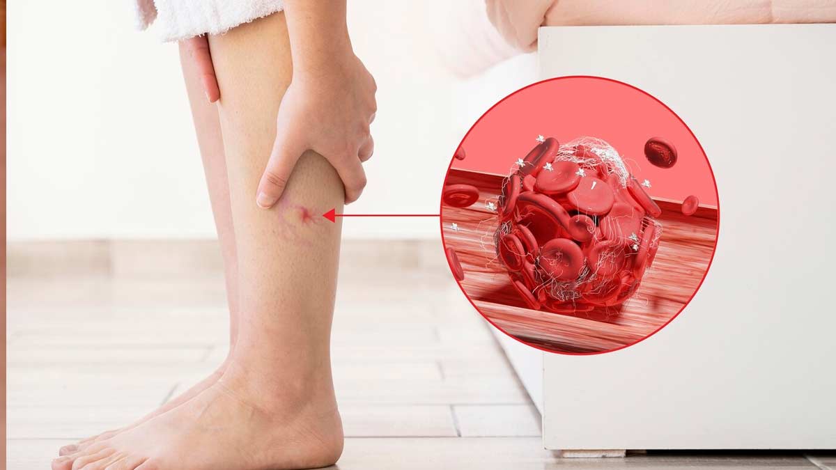 blood clotting after surgery