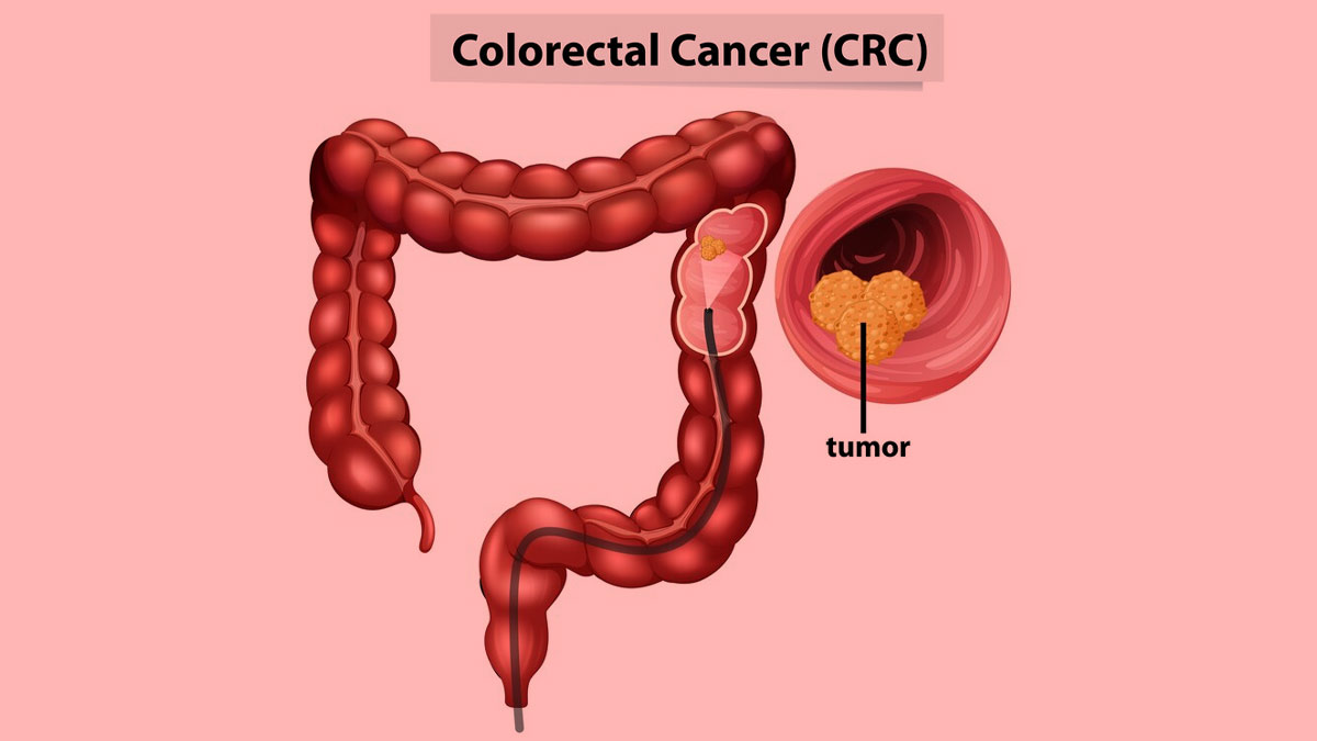 National Colorectal Cancer Awareness Month 2024: Know About The Warning Signs Of Colorectal Cancer