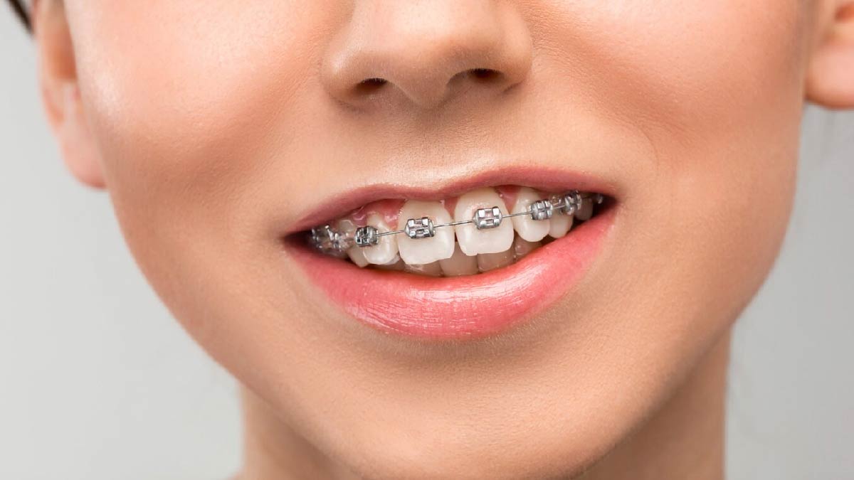 Can Braces Change Your Face Shape