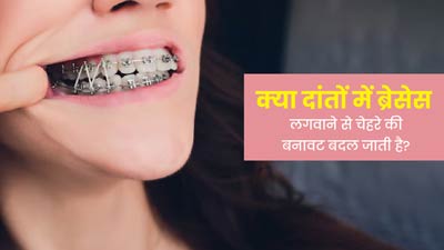 क्या दांतों में ब्रेसेस (दांतों में तार) लगवाने से चेहरे की बनावट बदल जाती है? जानें सावधनियां