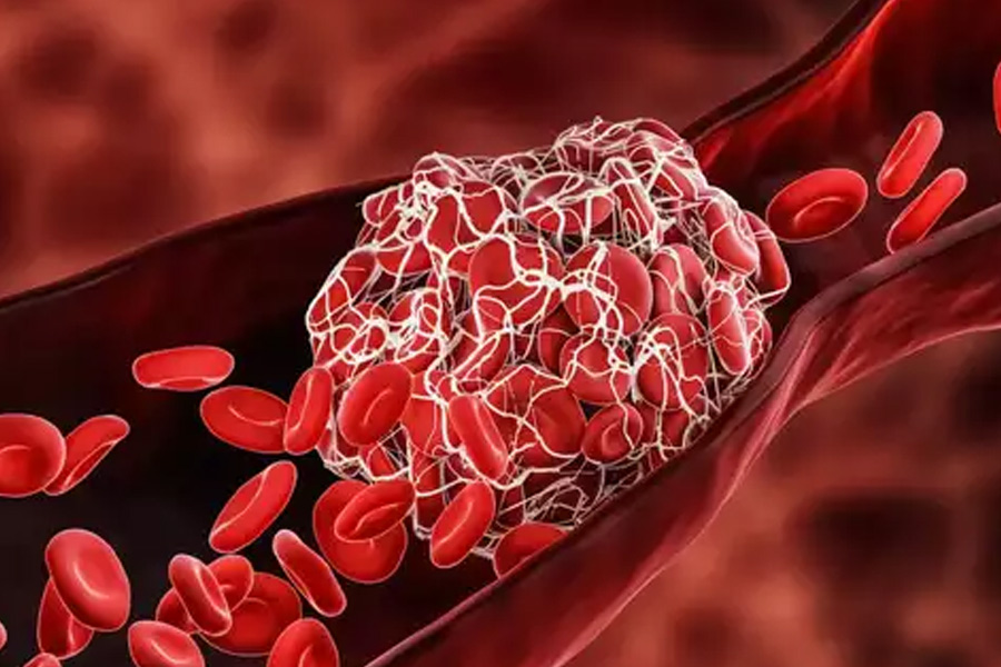 AstraZeneca Admits Covishield Jab Causes TTS; All About Thrombosis ...