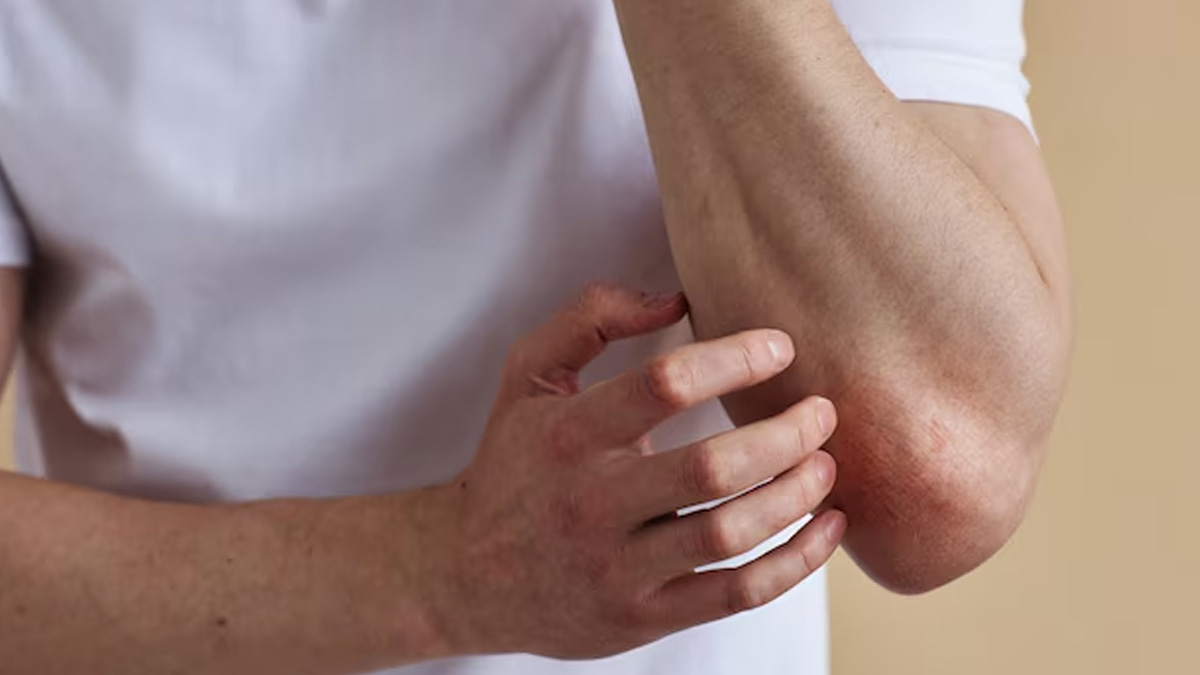कोहन‍ियों पर क्‍यों महसूस होती है खुजली की समस्‍या? डॉक्‍टर से जानें इसका कारण और घरेलू उपाय 