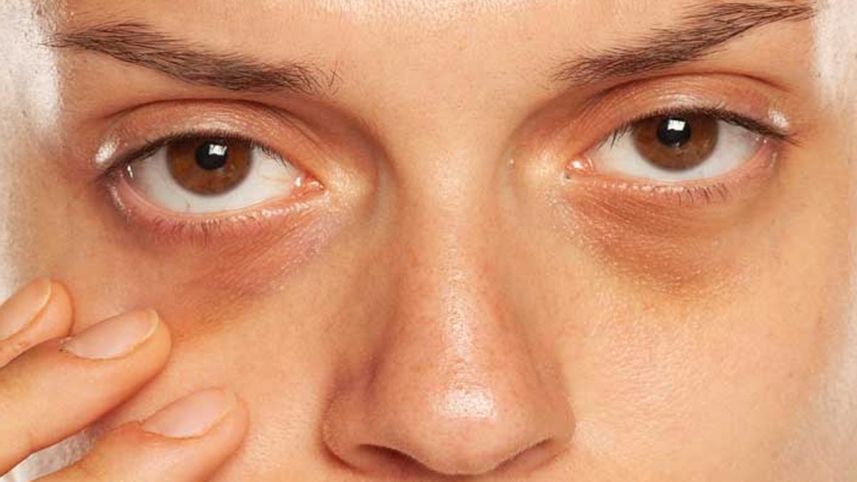 आईब्रो के गलत ट्रीटमेंट के कारण दो महिलाओं को हुई Sarcoidosis की समस्या, जानें इसके बारे में 