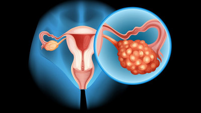 गर्भाशय फाइब्रॉएड होने पर डाइट में करें ये 5 बदलाव, रिकवरी में मिलेगी मदद