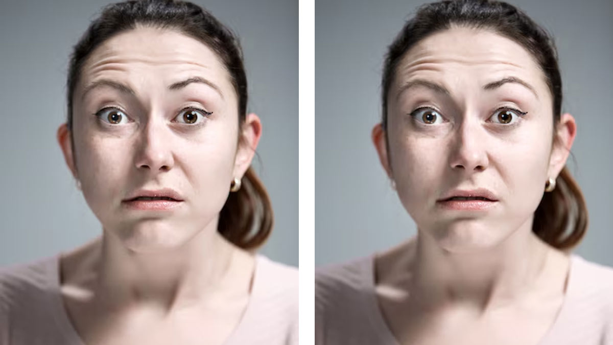 Do You Have Expression Lines? Here Are Effective Methods To Bid Goodbye To Them 