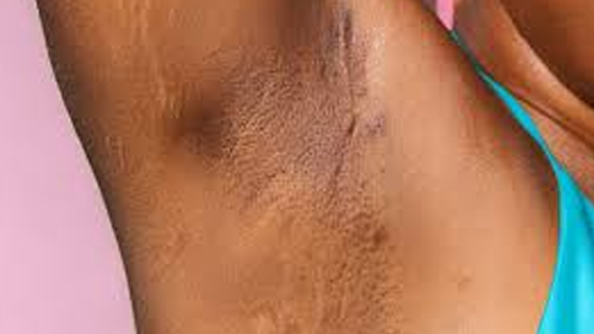 Causes Of Acanthosis Nigricans In Hindi
