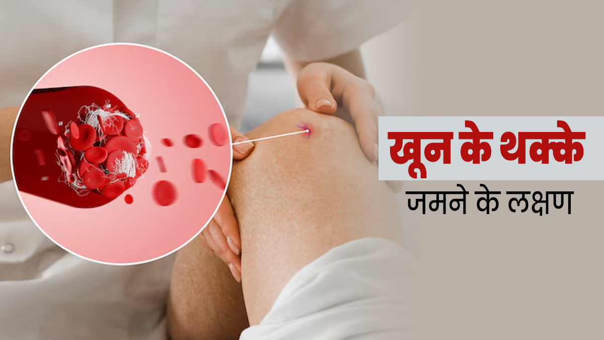 कोविशील्ड वैक्सीन के कारण खून के थक्के जमने की बात आई सामने, जानें क्या होते हैं इसके लक्षण