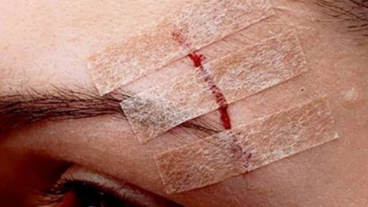 बटरफ्लाई बैंडेज क्‍या होता है? जानें क‍िस तरह की चोट में पड़ती है इसकी जरूरत