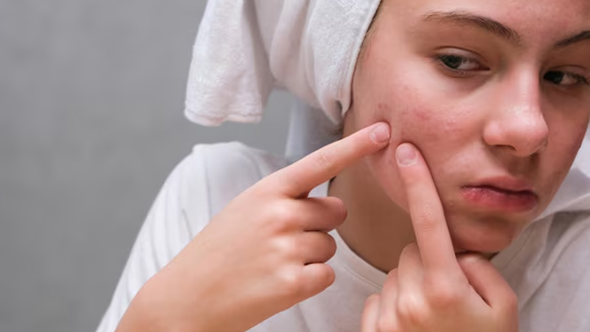 adult acne causes and treatment