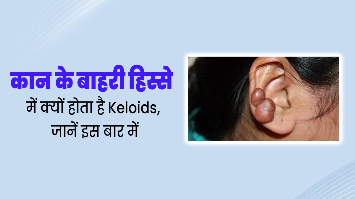 कान के बाहरी हिस्से में क्यों उभर आता है यह केलॉइड्स (keloids), जानें इसके कारण और इलाज 