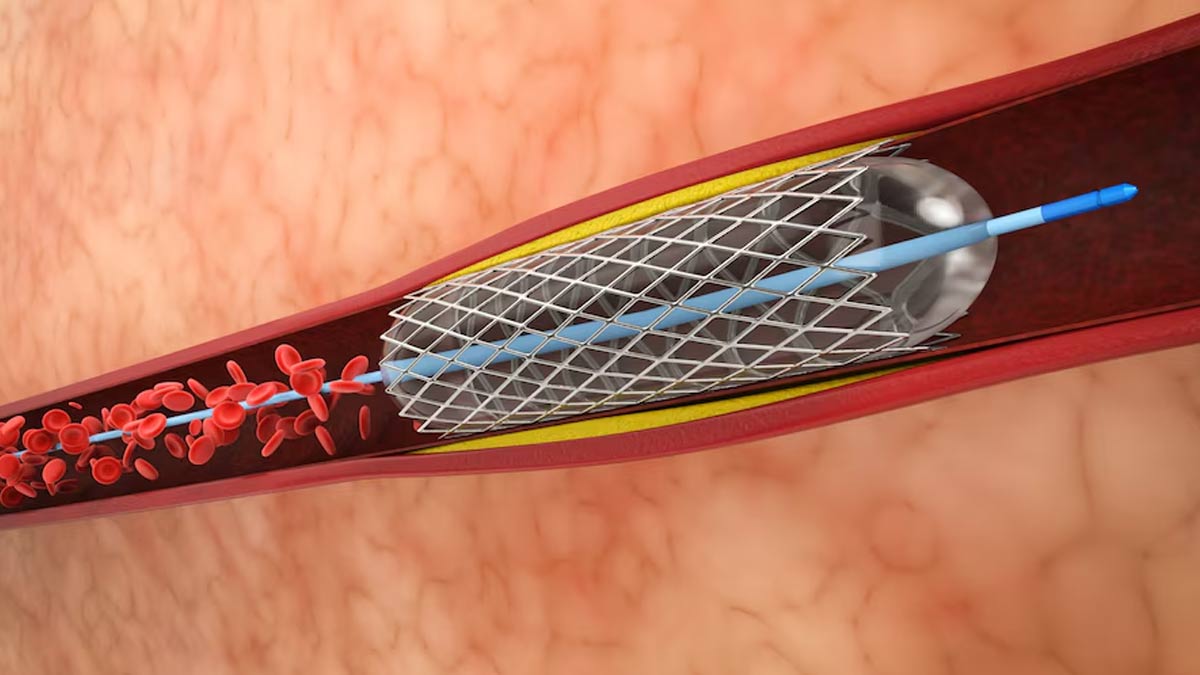 MITRACLIP And Angioplasty Procedure Gives A New Lease of Life to Patients Suffering from Heart Failure