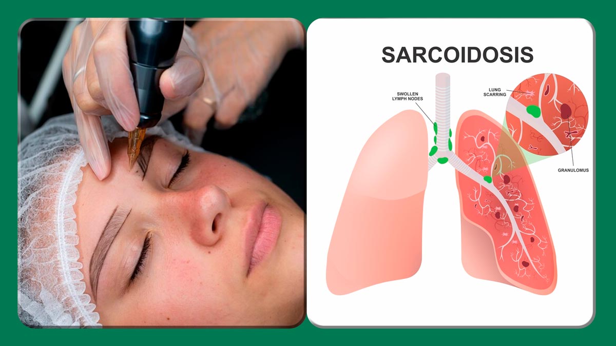 Two Women Develop Lung Condition After Eyebrow Treatment; Know All About Sarcoidosis