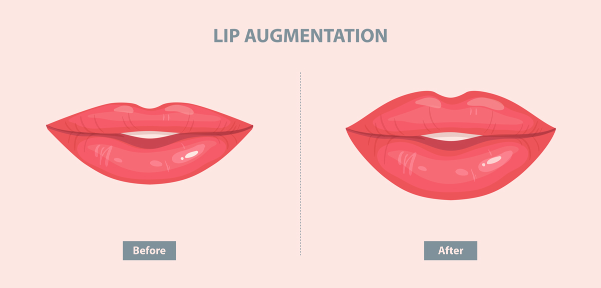 Lip Fillers