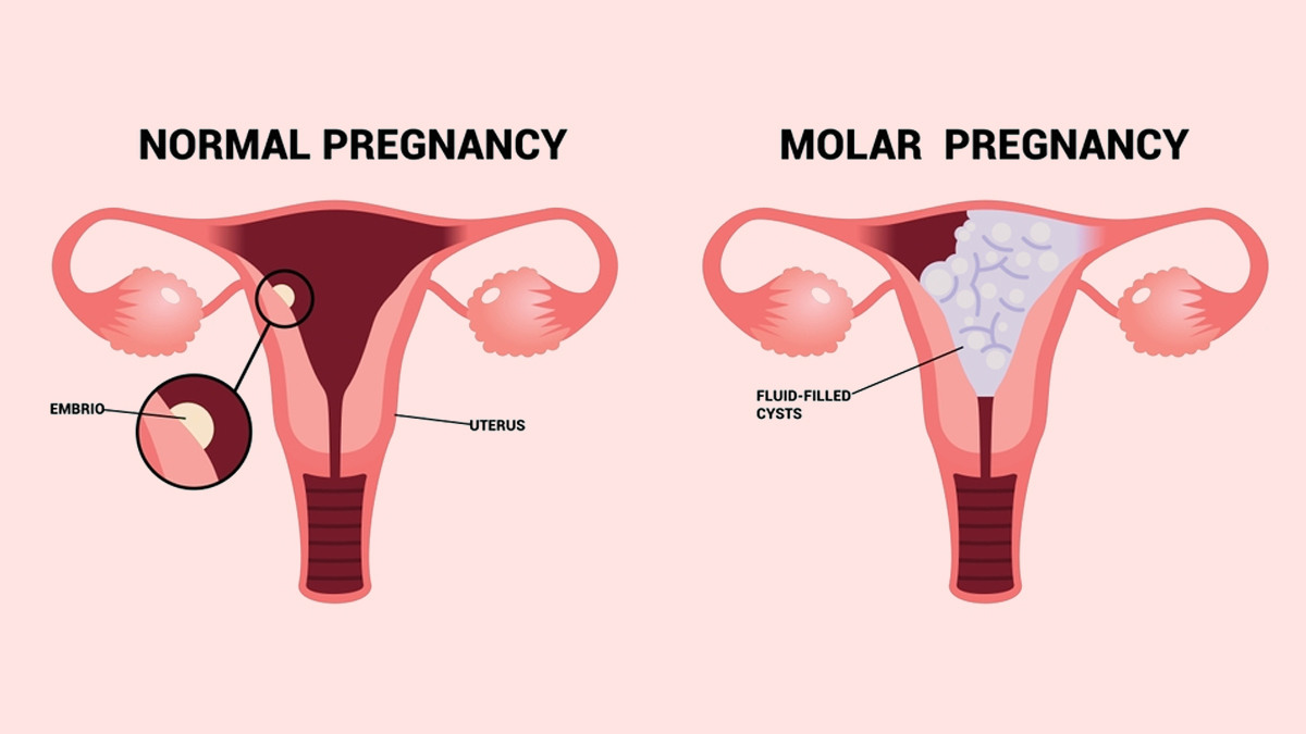molar-pregnancy
