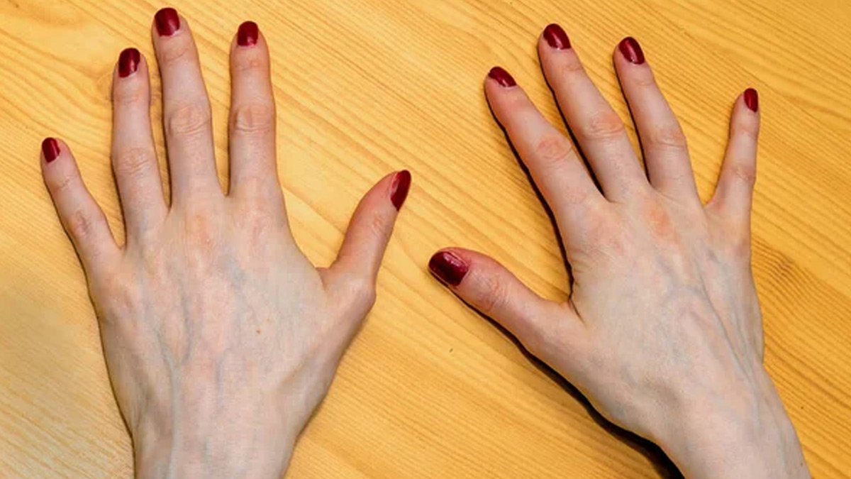 causes of thin hands