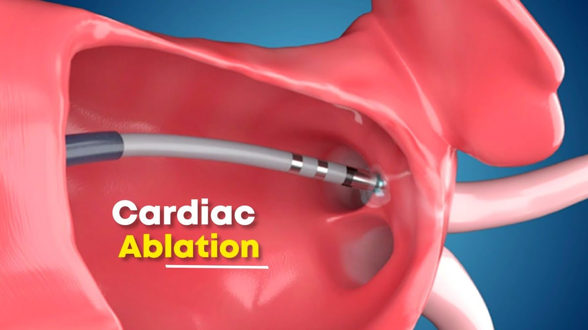 cardiac ablation 
