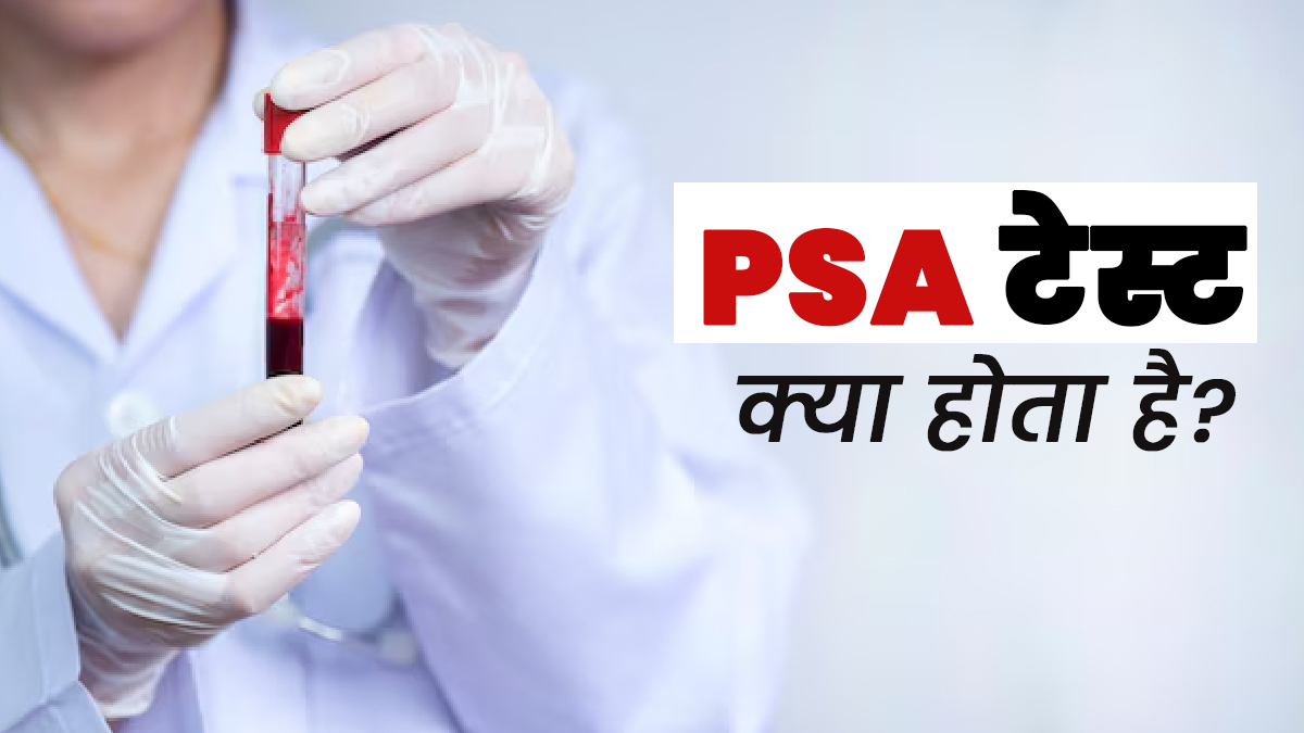 PSA टेस्ट क्या होता है? जानें किन स्थितियों में पड़ती है इसकी जरूरत