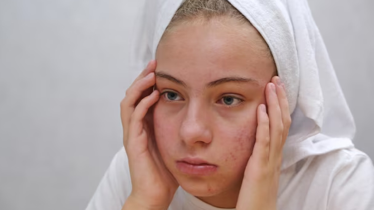 ACNE