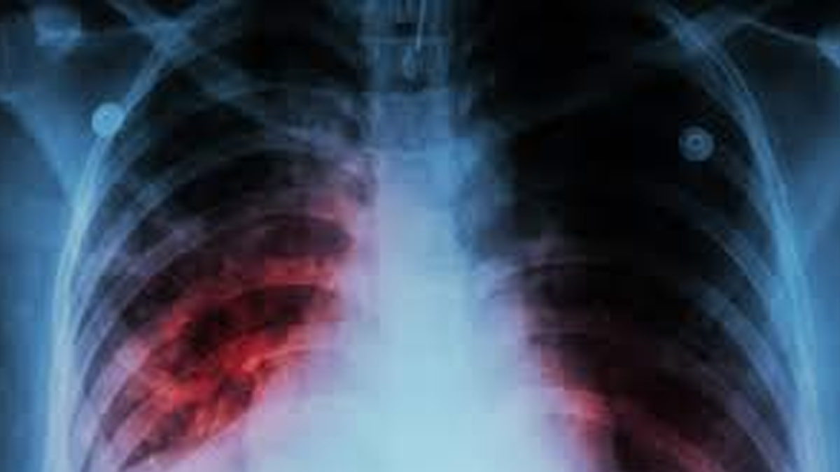 California City Declares A Public Health Emergency After Tuberculosis Sickens 14; Symptoms To Look Out For