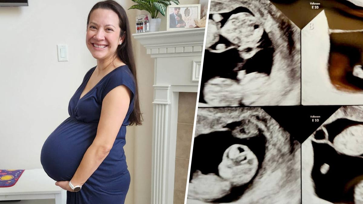 Texas Couple Welcomes Identical Quadruplet Girls; Complications of Multiple Pregnancy
