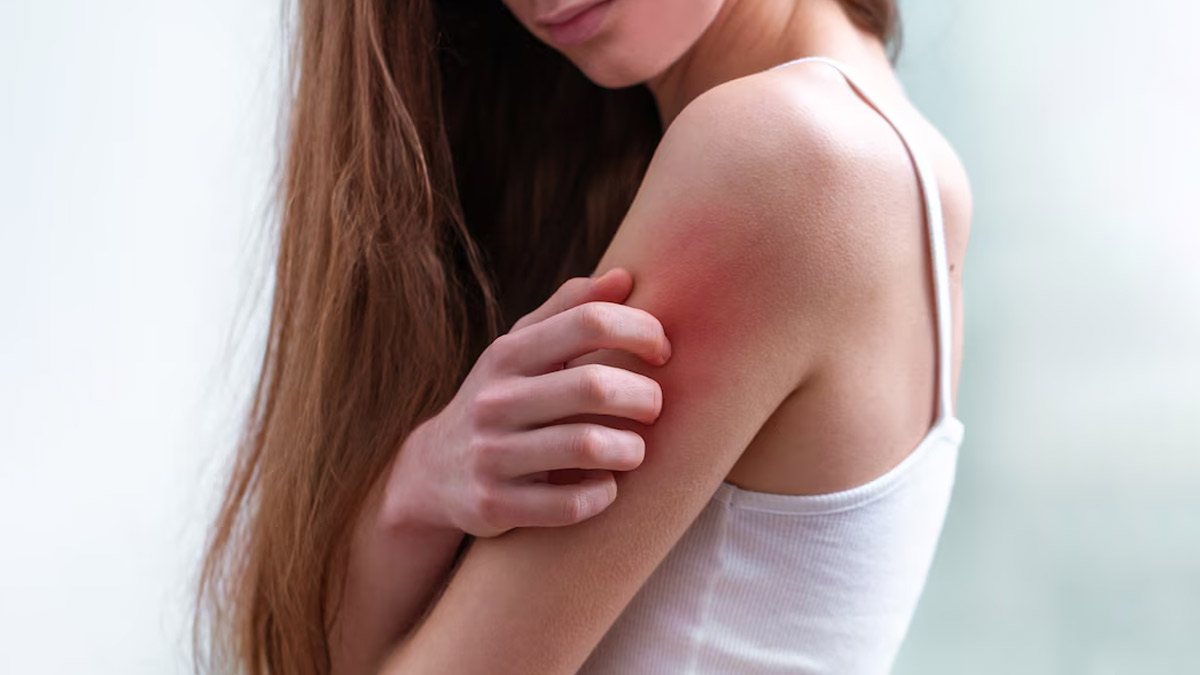 Preventing Heat Rash: Hygiene Tips To Practise If You Sweat A Lot