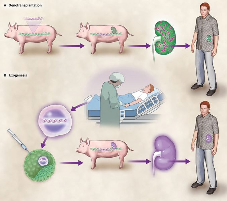 Pig Kidney Transplant