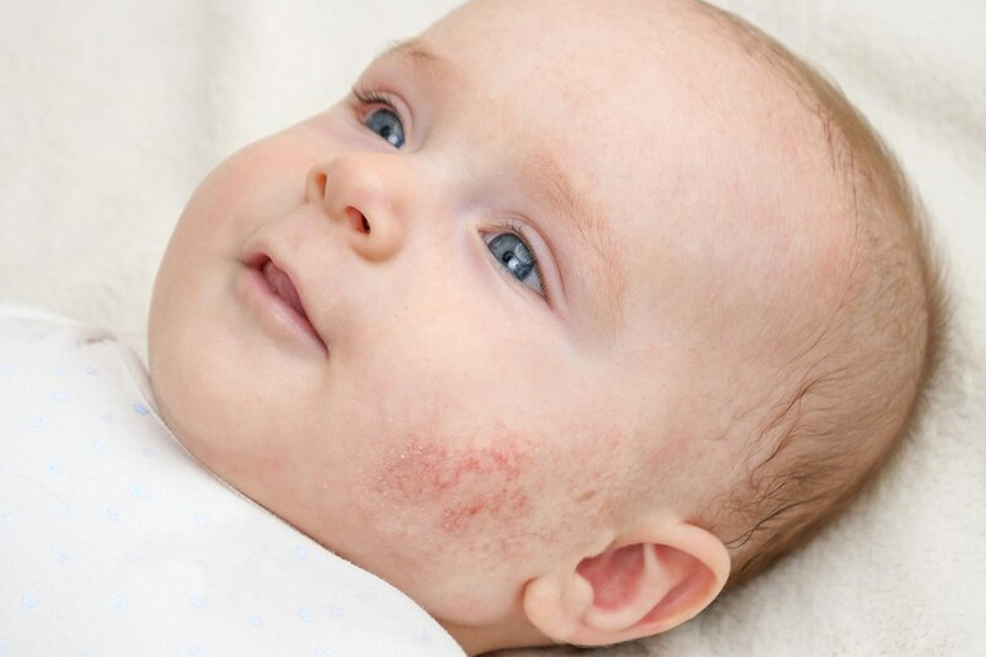 rash