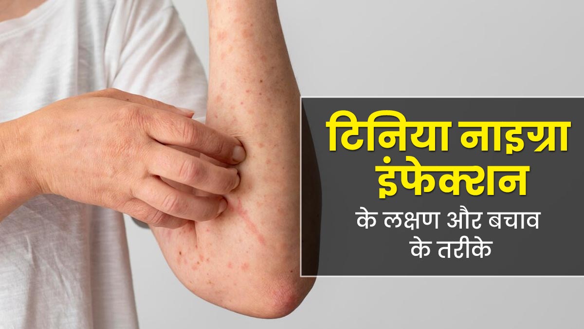 गर्मियों में बढ़ जाता है टिनिया नाइग्रा इंफेक्शन का जोखिम, एक्सपर्ट से जानें इसके लक्षण और बचाव के तरीके