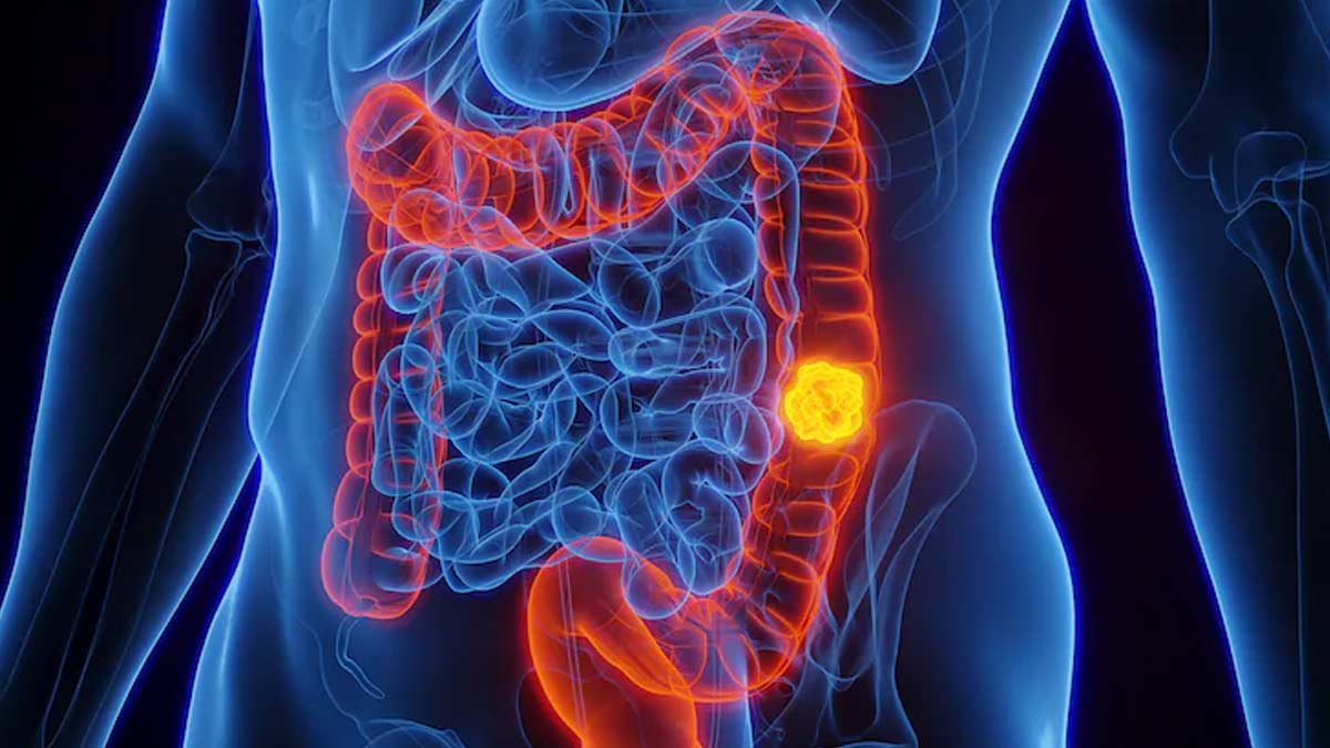 Colon Cancer Rates Have Been Rising For Decades In Younger People, Study Finds; What Might Be The Causes?