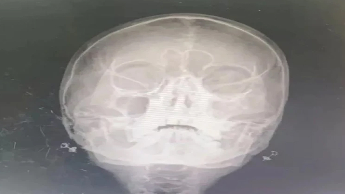 Thousands Of Maggots Found In Thai Woman's Blocked Nose: Here's What You Need To Know 