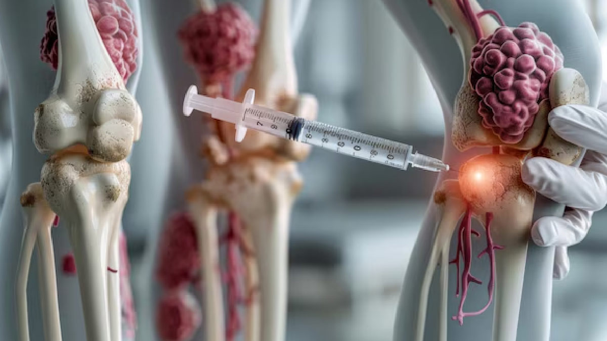 Is Osteosarcoma Bone Cancer Curable 