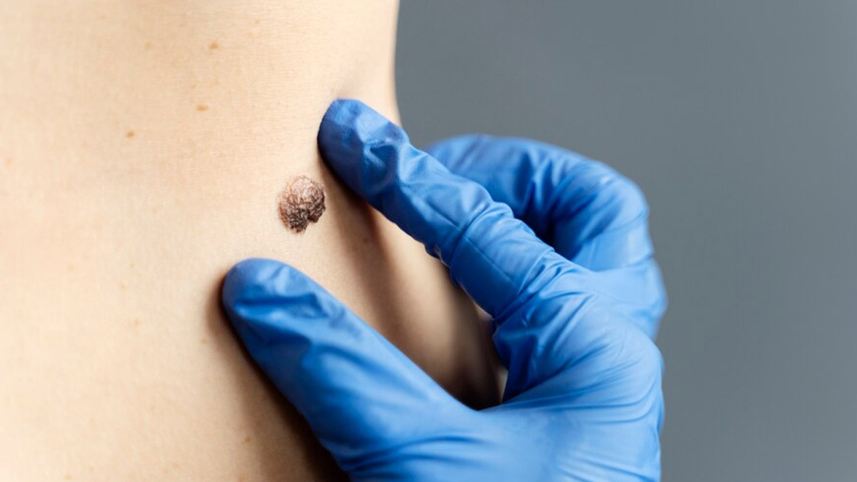 Skin Cancer Awareness Month: Understanding The Role Of Sunscreen Usage And How To Pick The Best One