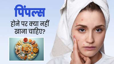 पिंपल्स होने पर क्या नहीं खाना चाहिए? जानें डाइटिशियन से