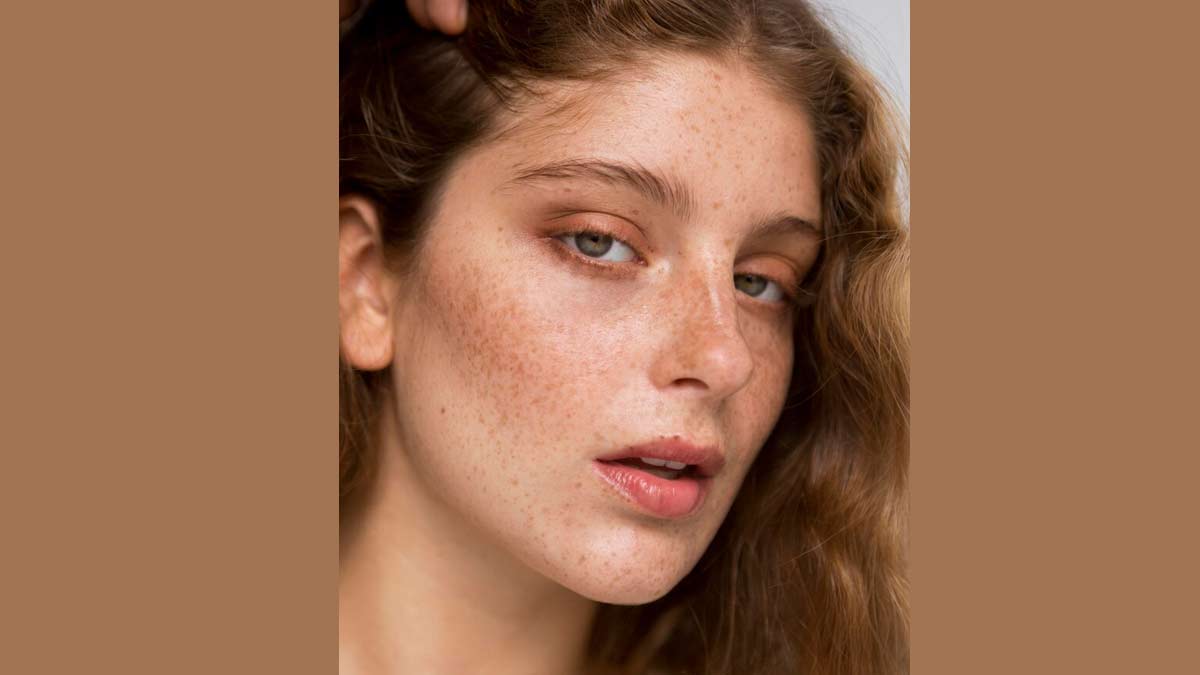 MELASMA