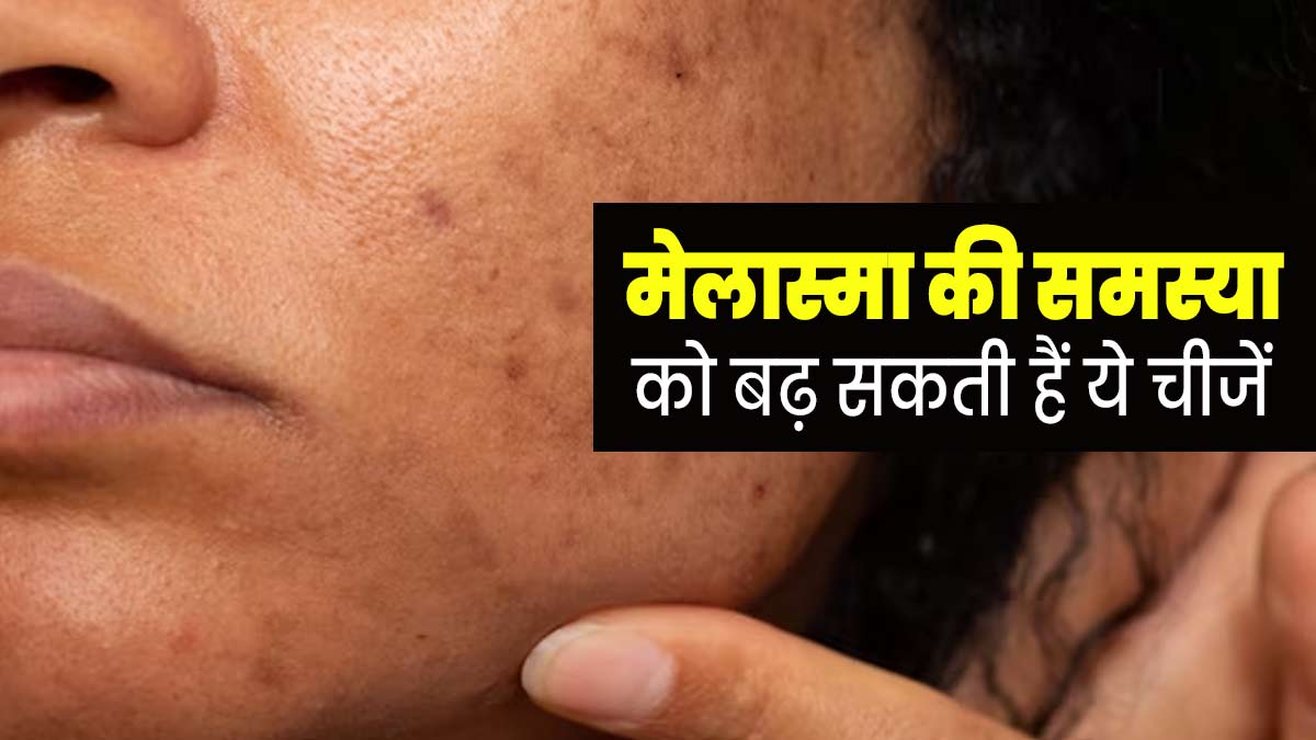 Melasma: मेलास्मा (काले धब्बे) की समस्या बढ़ा सकती हैं ये 5 चीजें, जरूर बरतें सावधानी