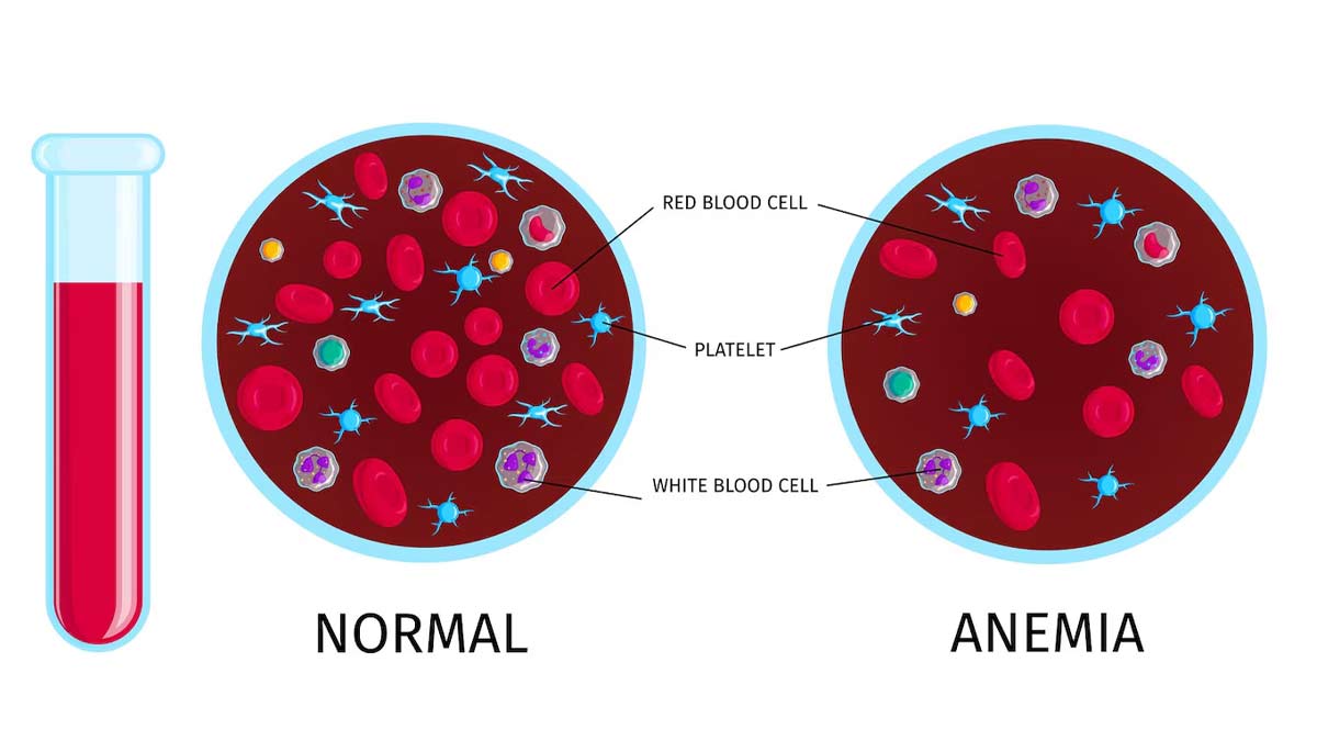 Is Severe Anemia Life Threatening In Hindi