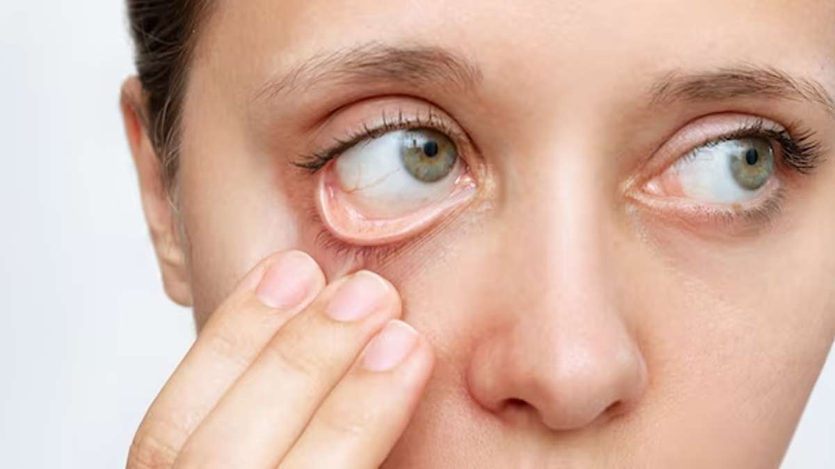 Symptoms Of Anemia In Hindi