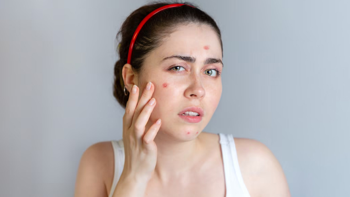 क्या खराब खानपान से मुंहासों की समस्या होती है? जानें डाइट और एक्ने में संबंध