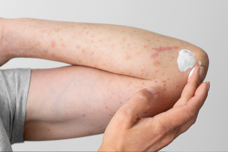 Dealing With Eczema Scars Expert Lists Its Causes Treatment And Prevention Measures