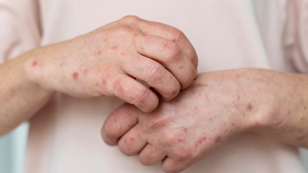 Dealing With Eczema Scars? Expert Lists Its Causes, Treatment, And Prevention Measures