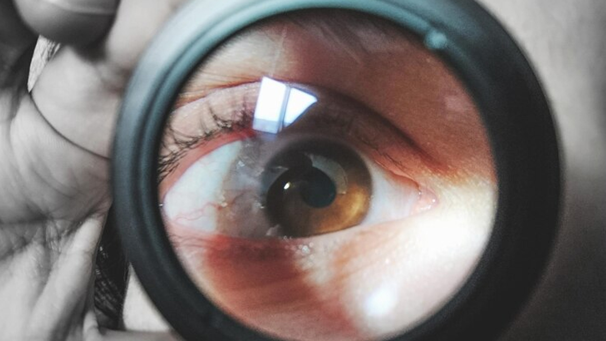 Your Nails Can Signal If You Are Prone To Cancer: NIH Highlights Benign Nail Condition Linked to Rare Syndrome