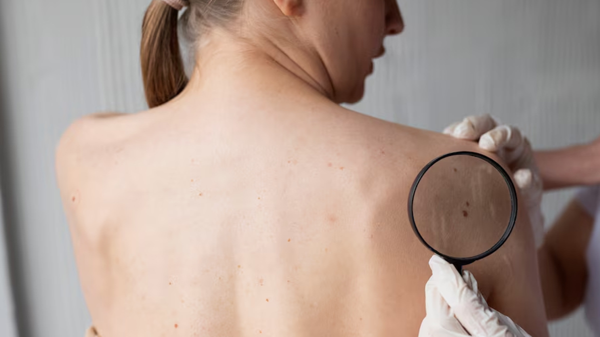 Your Nails Can Signal If You Are Prone To Cancer: NIH Highlights Benign Nail Condition Linked to Rare Syndrome