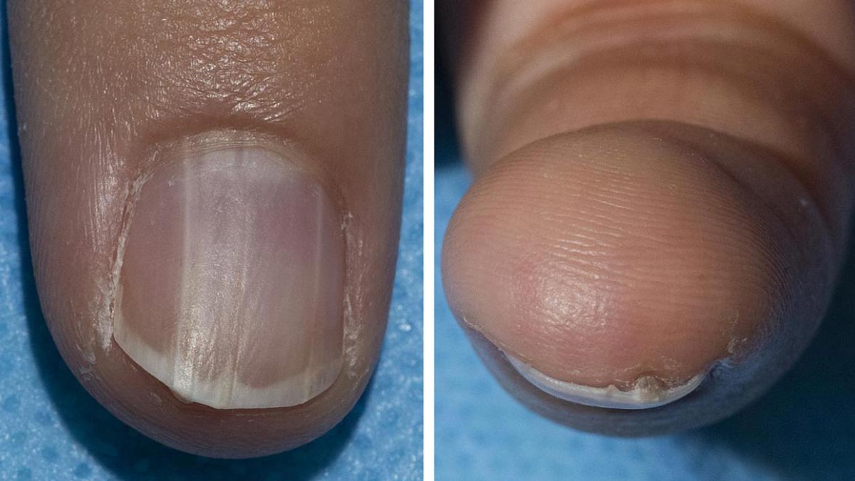 Your Nails Can Signal If You Are Prone To Cancer: NIH Highlights Benign Nail Condition Linked to Rare Syndrome