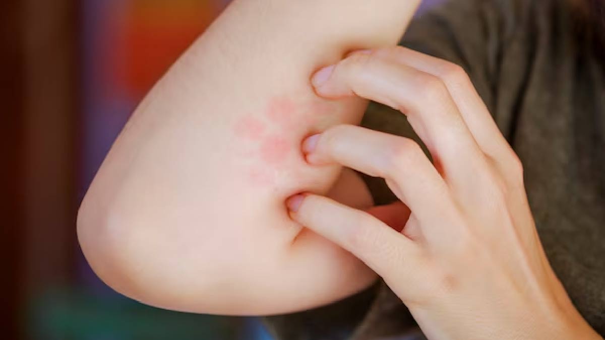 How Atopic Dermatitis Can Increase Your Risk Of Food Allergies