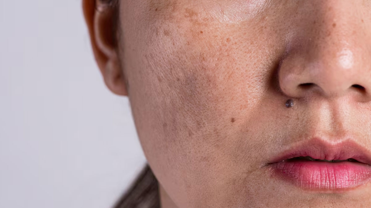 Home Remedies: How To Treat Melasma At Home Naturally
