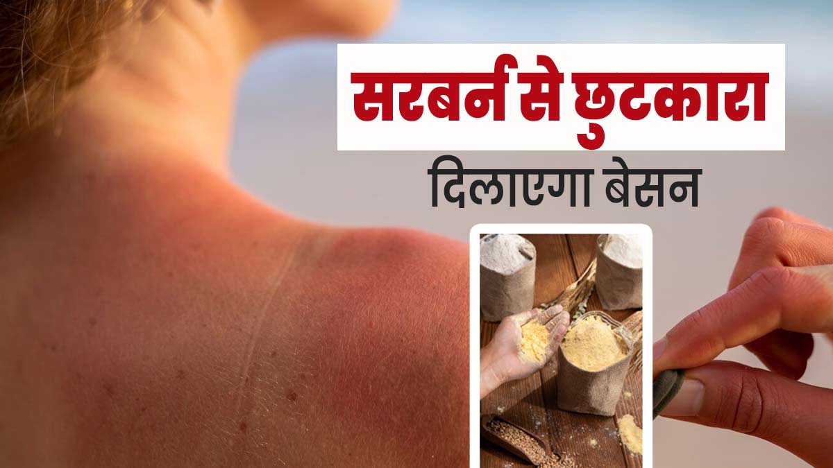 गर्मियों में सनबर्न से छुटकारा दिलाएगा बेसन, इन 2 तरीकों से करें इस्तेमाल
