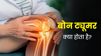 बोन ट्यूमर क्या होता है? जानें इसके कारण और पहचान करने का तरीका